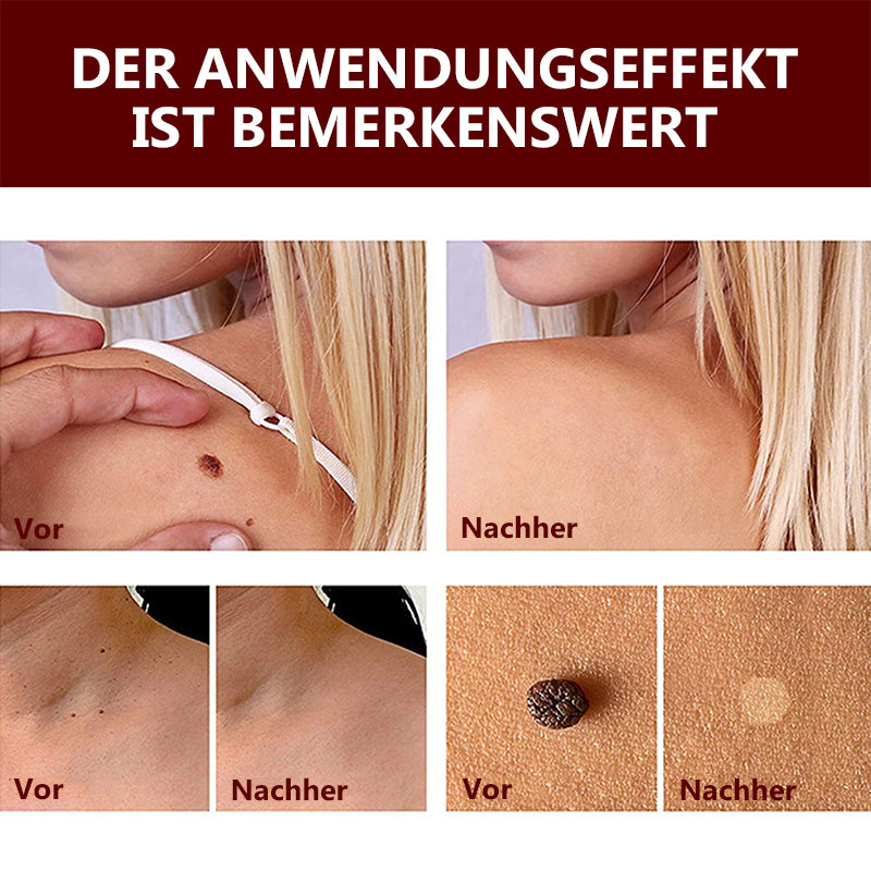 Essenz zur Entfernung von Flecken und Muttermalen - 1 kaufen, 1 gratis erhalten (2 Stück)